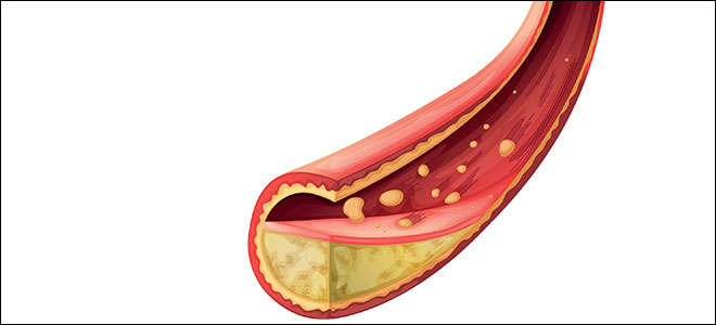 Illustrasjonsbildet viser hvordan blodåren kan tettes av fettansamlinger. 