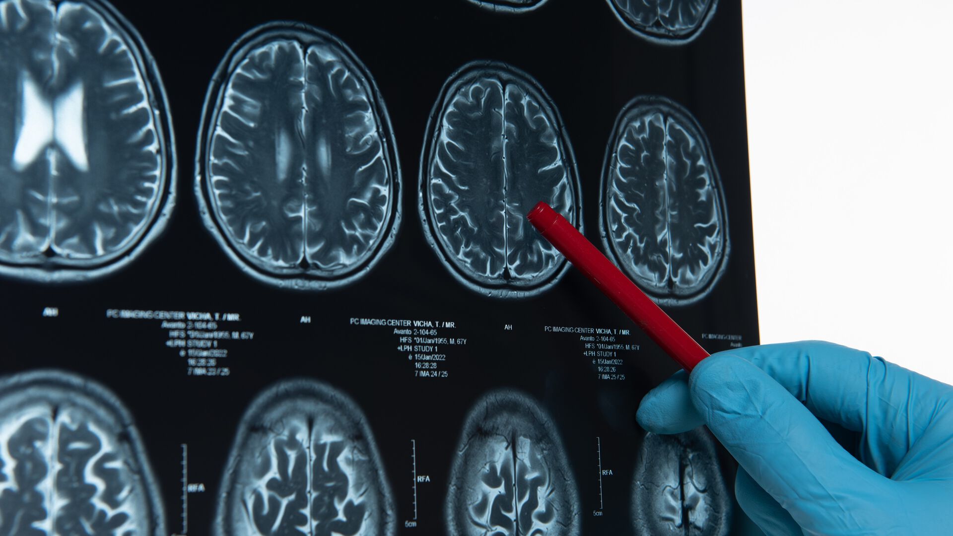 Bildet kan inneholde: medisinsk avbildning, radiologi, hjerne, computertomografi, radiografi.