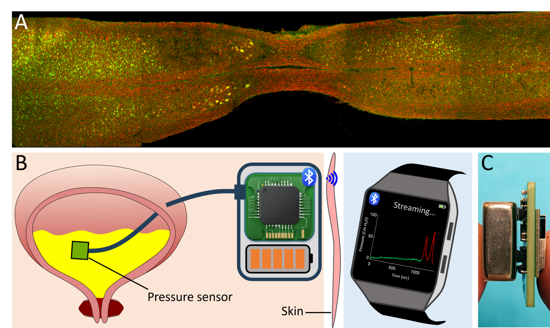 Confocal picture of the spinal cord after lesion (top). Implantable Bluetooth transceiver. Photo: Jean-Luc Boulland, UiO 
