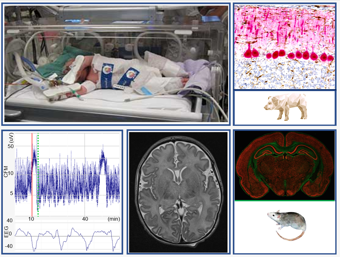 Photomontage: Intensive care nursery unit, brain scan and diagrams