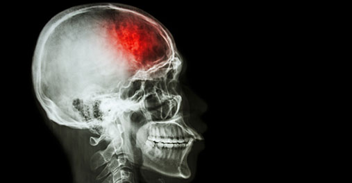 X-ray of the skull of a patient suffering from stroke, affected area colored red