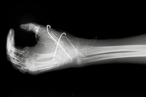 Røntgenbilde, brudd i hånd