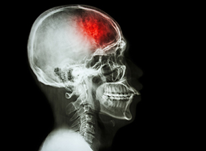 Røntgenbilde av hodet til en pasient med slag