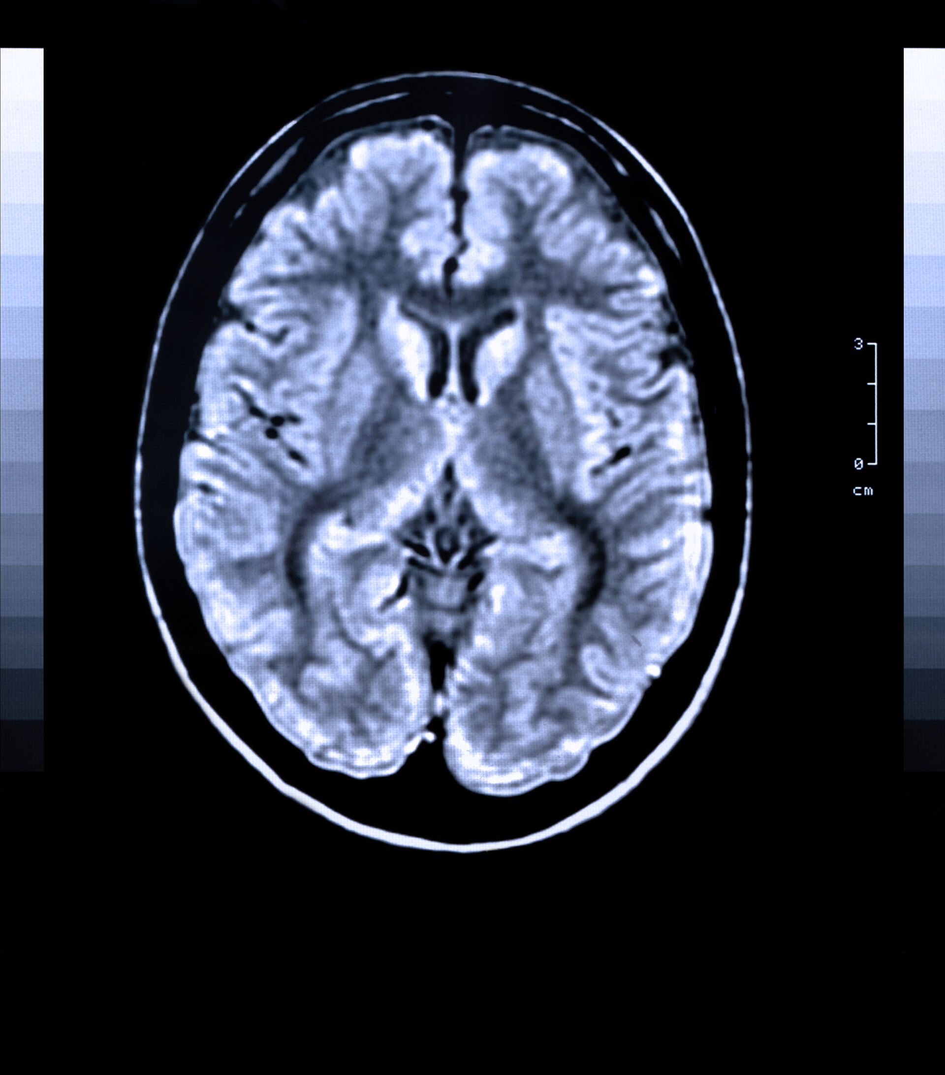 MRI image of brain. 