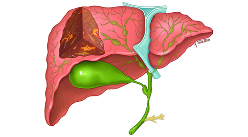 Illustrasjon av lever rammet av primær skleroserende cholangitt (PSC).