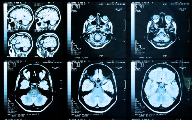 Bildet viser MR-bilder av hjernen.