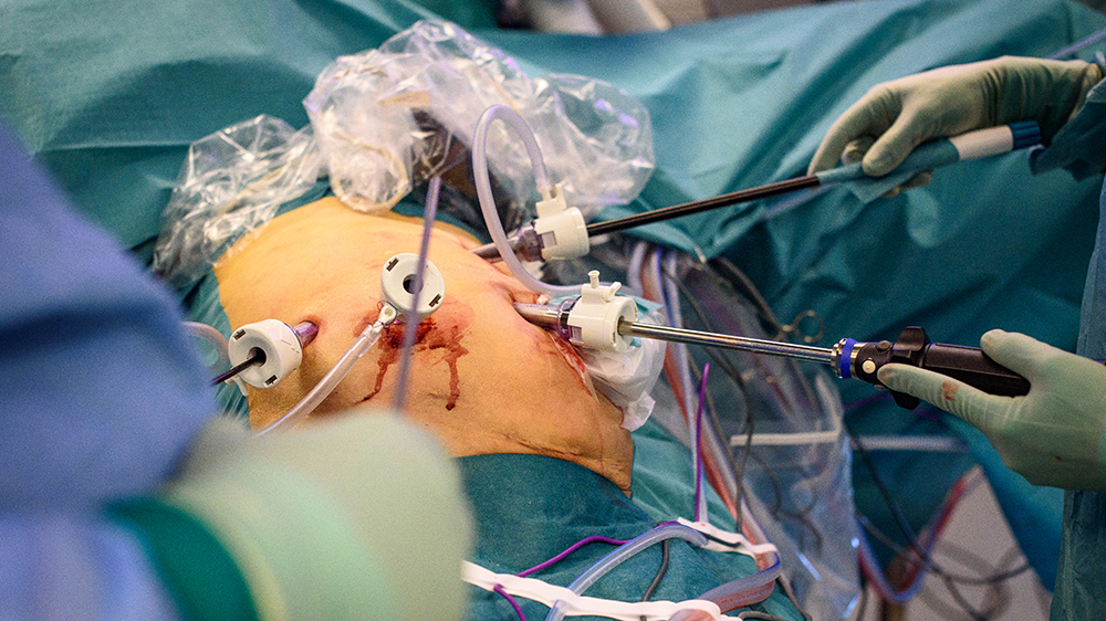 Bildet viser instrumenter som går inn i en pasients mage gjennom små hull.