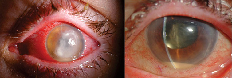 Bilde av to øyne som har den alvorlige øyeinfeksjonen endoftalmitt.