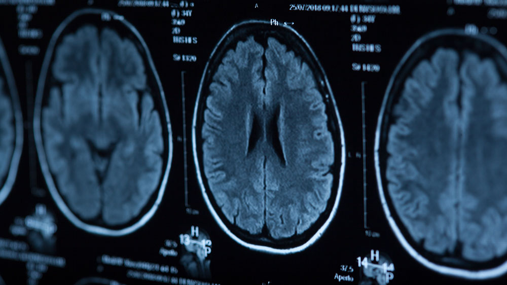 Røntgenbilder av hjernen