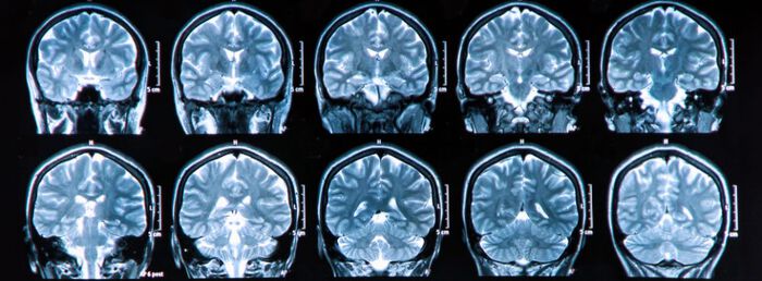 Bilde av MR scan av hjernen