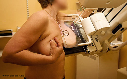 Bilde av røntgenundersøkelse av brystene. 