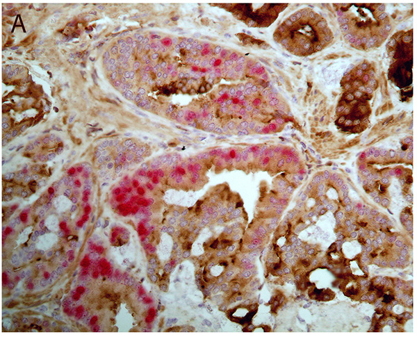 image of prostate cancer cells