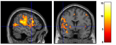bilder fa hjernescanninger. Aktive områder lyser opp i gult og orange.