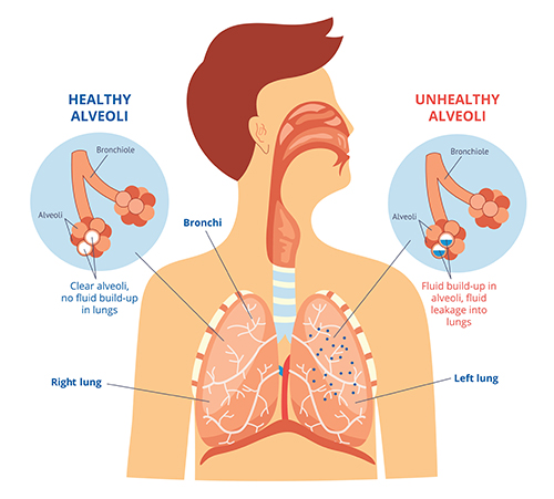 Tegnet illutrasjon av lunger med friske luftfylte alveoler og syke værskefylte alveoler.