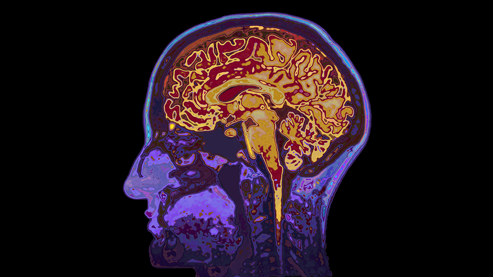 Fargerikt MRI bilde av frisk hjerne.